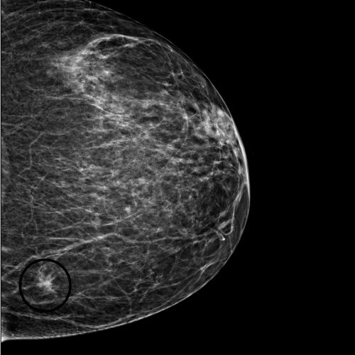 Mammografie-mit-kleinem-Brustkrebs-800x800px_web